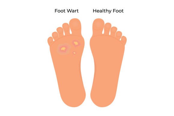 Download Foot Wart Vs Healthy Foot a Comparative - Comparative Collection